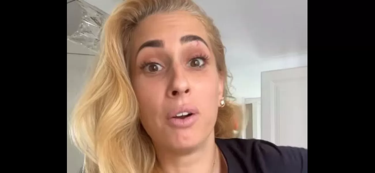 Stacey Solomon accidentally injured herself at home, resulting in a black eye.