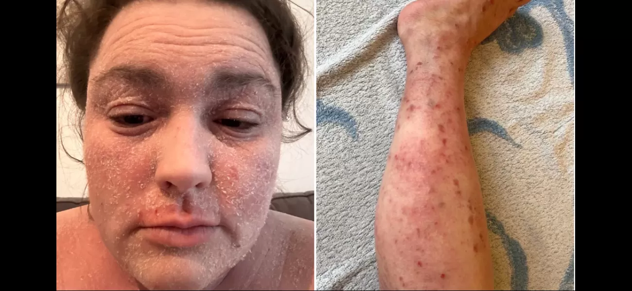 Skin condition caused unemployment and isolation, but community support changed that.