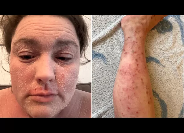 Skin condition caused unemployment and isolation, but community support changed that.