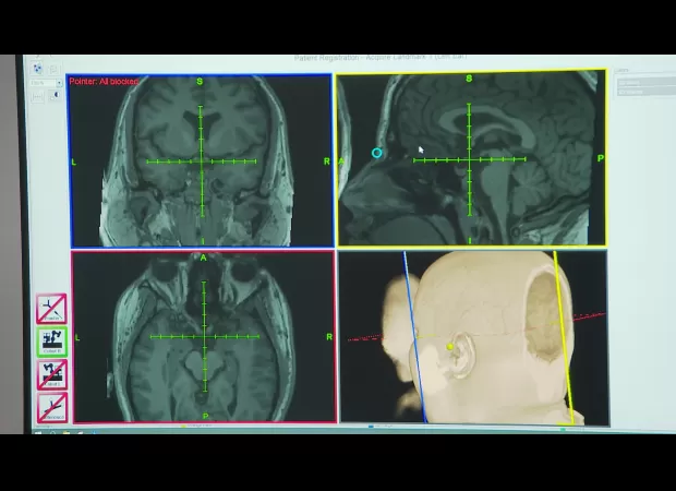 A new personalized 'zap' is being developed to help treat depression.