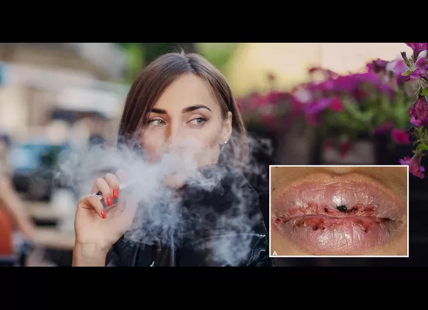 A one-year vaping habit caused severe mouth ulcers that made eating impossible for a woman.