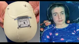 First person with epilepsy fitted with seizure-controlling device.
