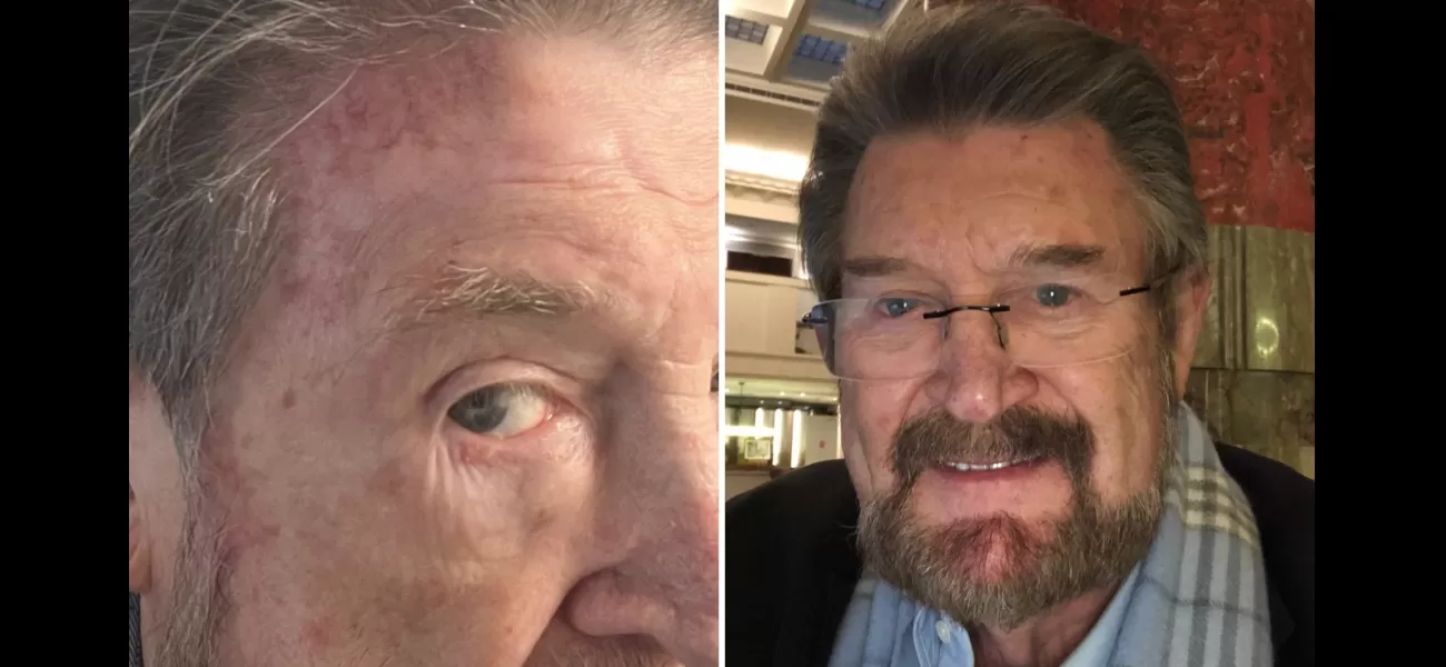 Derryn Hinch, known in the media, discloses struggle with skin cancer.