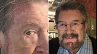 Derryn Hinch, known in the media, discloses struggle with skin cancer.
