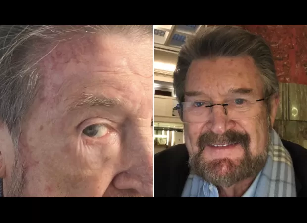 Derryn Hinch, known in the media, discloses struggle with skin cancer.