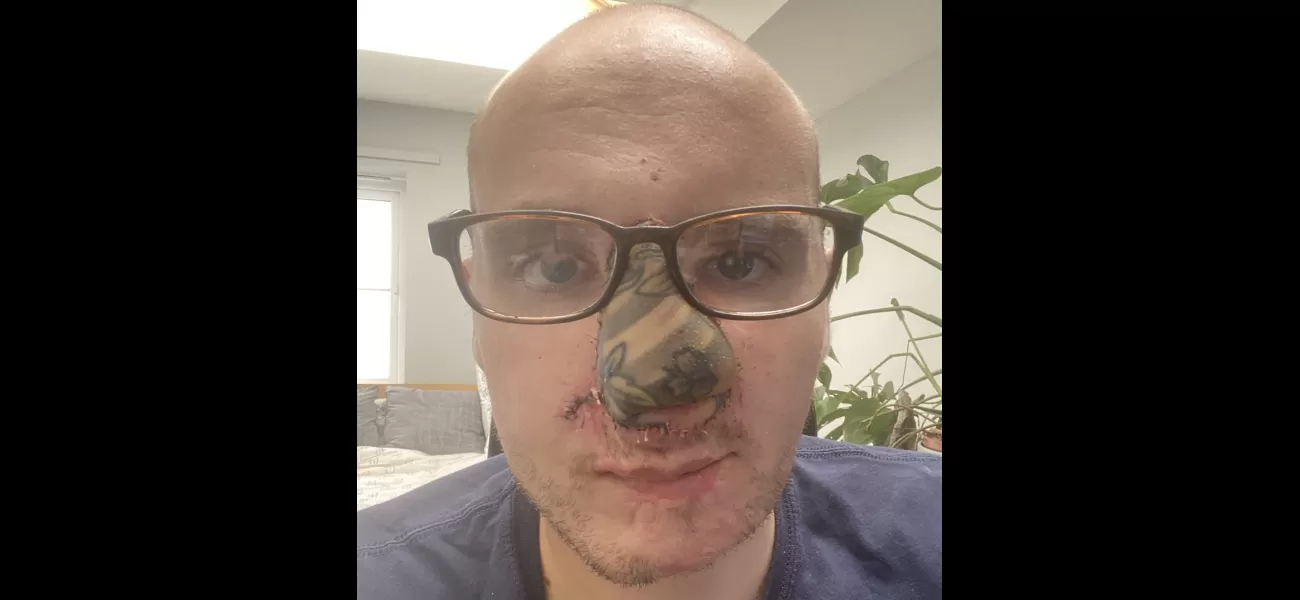 A dog panicked and bit its owner's nose, which was then replaced with tattooed skin from their arm.