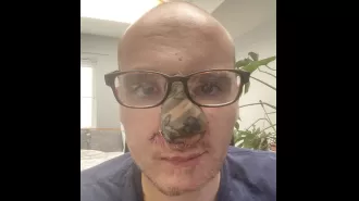 A dog panicked and bit its owner's nose, which was then replaced with tattooed skin from their arm.