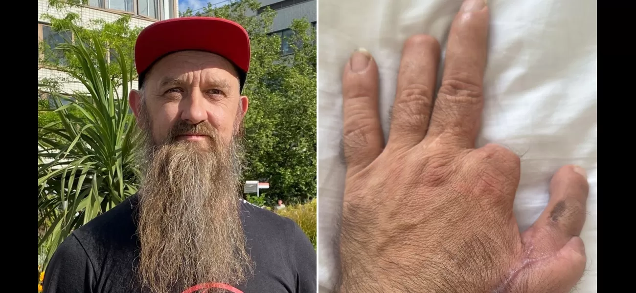 Man who lost fingers in accident resumes carpentry after receiving transplant.