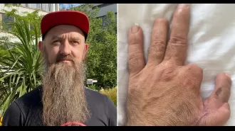Man who lost fingers in accident resumes carpentry after receiving transplant.