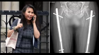 Banker files £1 million lawsuit over surgery that resulted in uneven leg lengths.