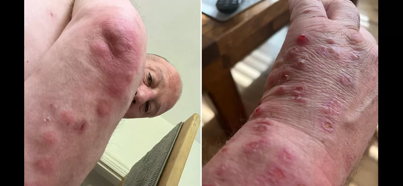 Dad got red, itchy bites from a used sofa bought at ScS.