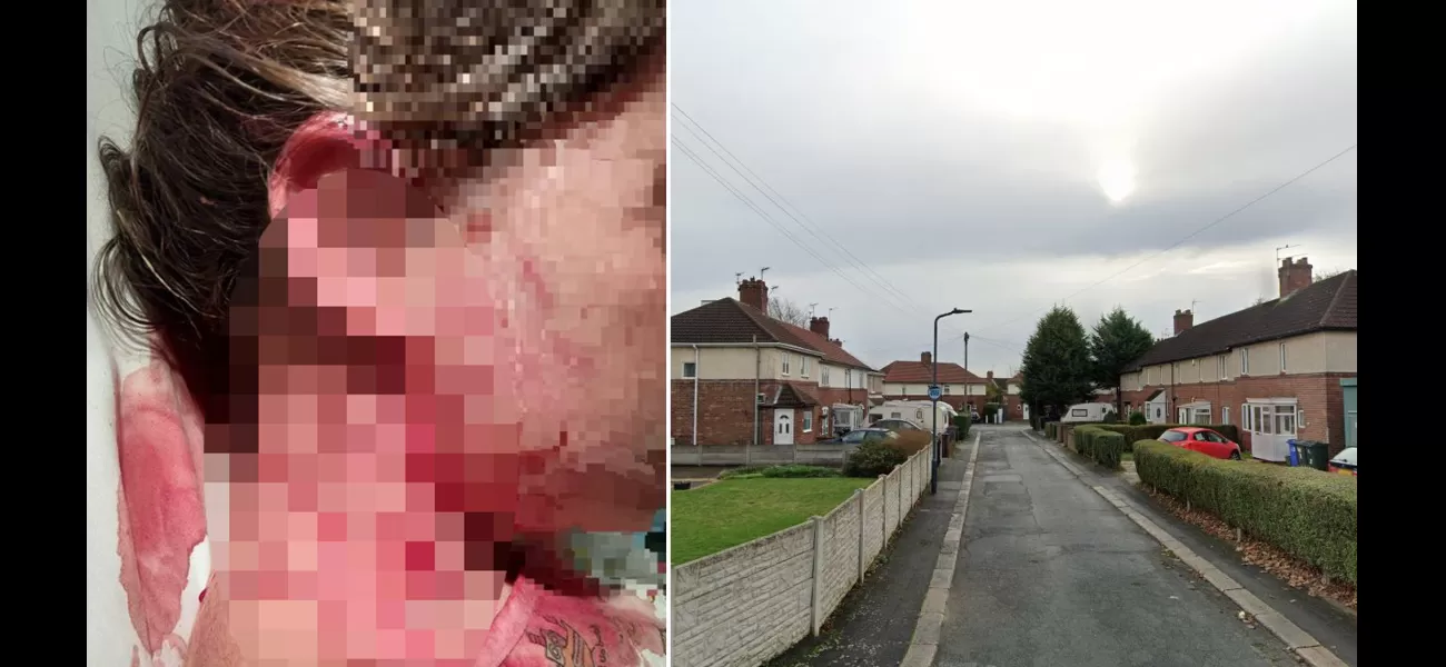 Child brutally attacked by unregistered aggressive XL Bully, sustaining serious injuries to neck and head.