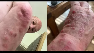 Dad got red, itchy bites from a used sofa bought at ScS.