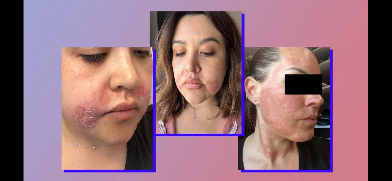 The swelling and blisters caused by Morpheus8 treatment lasted for weeks, but the potential results were not worth it.