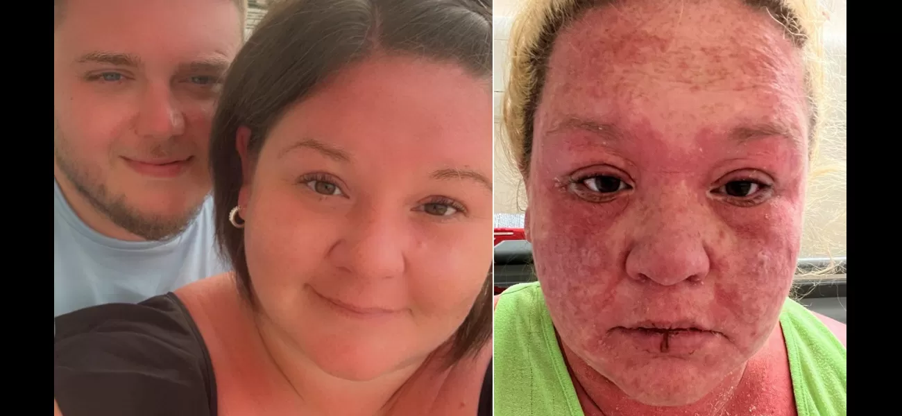 A woman's skin, hair, and nails peel off following a mosquito bite during her vacation.