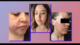 The swelling and blisters caused by Morpheus8 treatment lasted for weeks, but the potential results were not worth it.
