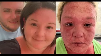 A woman's skin, hair, and nails peel off following a mosquito bite during her vacation.