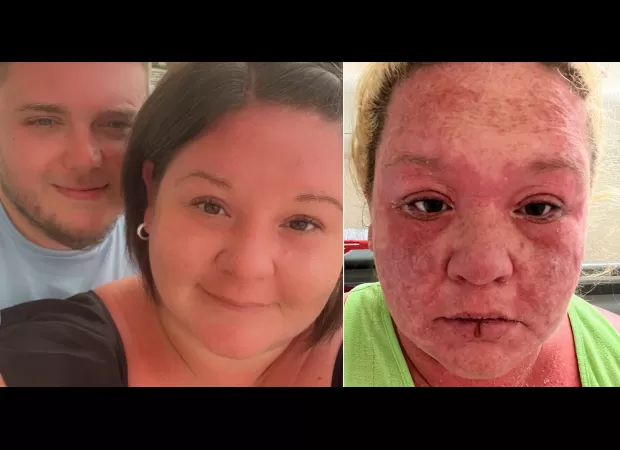 A woman's skin, hair, and nails peel off following a mosquito bite during her vacation.