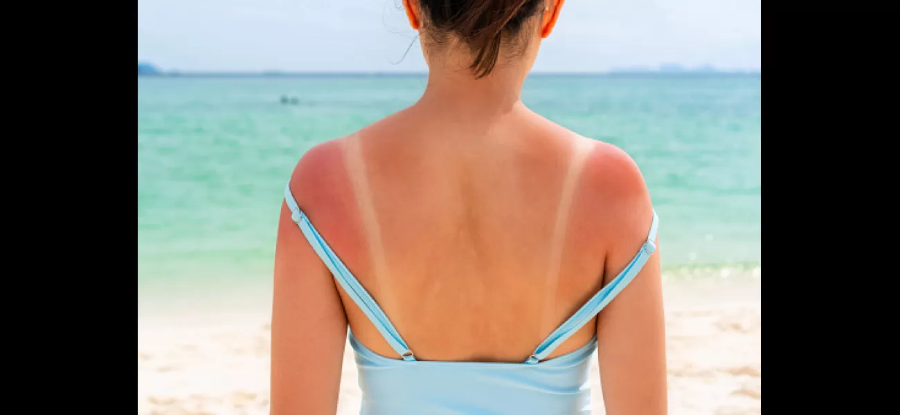 8 tips to relieve the pain of a sunburn during a heatwave.