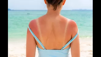 8 tips to relieve the pain of a sunburn during a heatwave.
