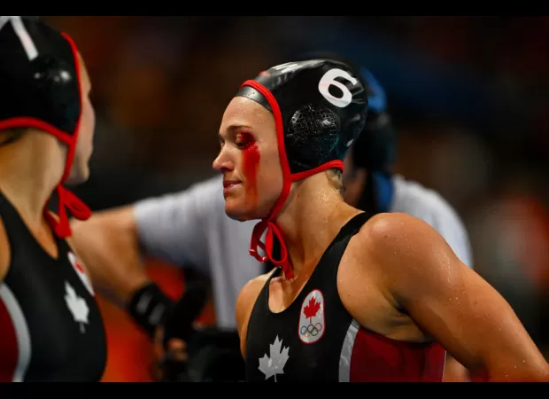 Water polo athlete injured in Olympics, resulting in bloody and gruesome eye injury.