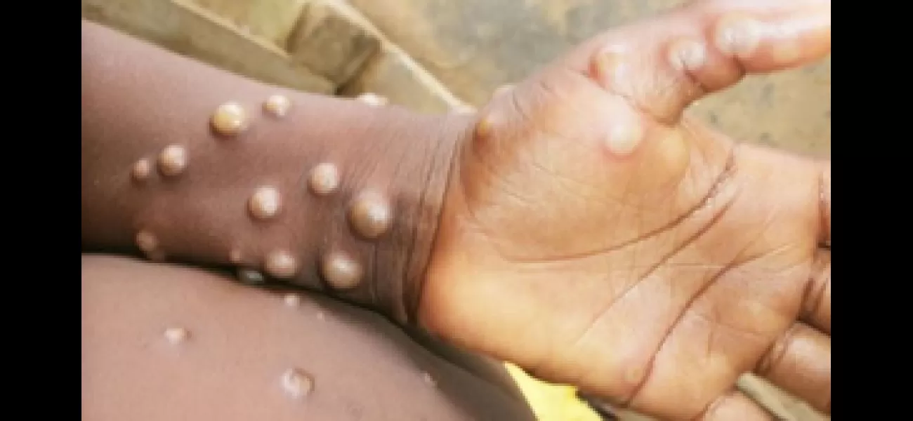 Pakistani health ministry reports 1st case of new mpox variant in Asia.