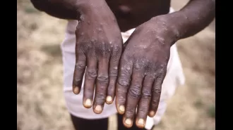 What is mpox and how can it be prevented?