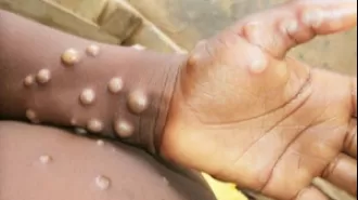 Pakistani health ministry reports 1st case of new mpox variant in Asia.