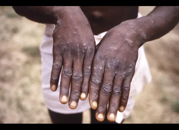 What is mpox and how can it be prevented?