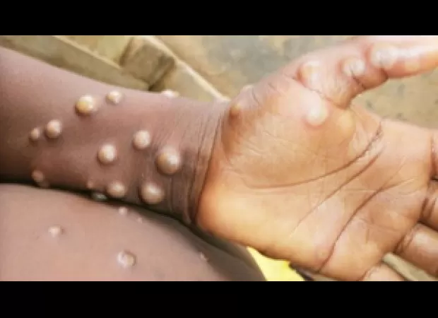 Pakistani health ministry reports 1st case of new mpox variant in Asia.