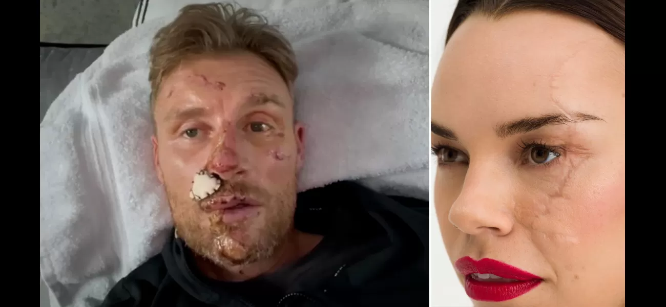 I admire Freddie Flintoff's facial scars and relate to them.