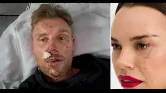 I admire Freddie Flintoff's facial scars and relate to them.