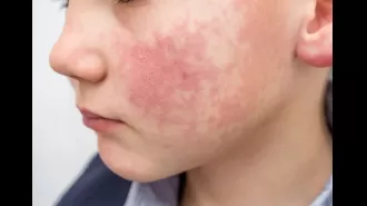 What is the virus that causes a red rash on the cheeks and how can it be treated?