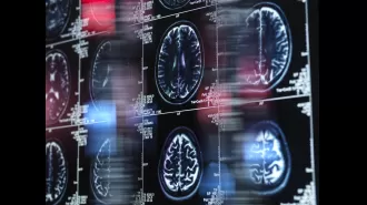 New Alzheimer's medication deemed too expensive for NHS coverage.