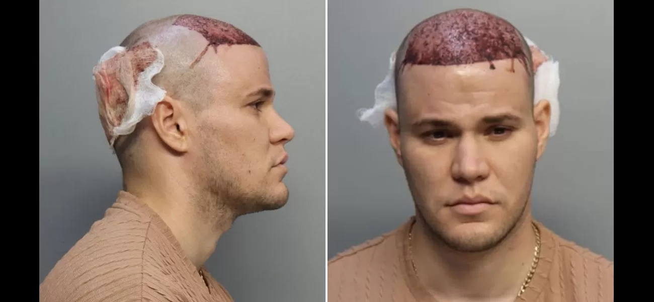 Man with hair transplant arrested on plane for refusing to leave due to bleeding.