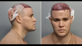 Man with hair transplant arrested on plane for refusing to leave due to bleeding.