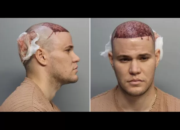 Man with hair transplant arrested on plane for refusing to leave due to bleeding.