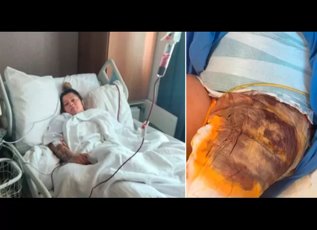 A mother from the UK suffered sepsis after a failed cosmetic surgery in Turkey. She had woken up during the procedure.
