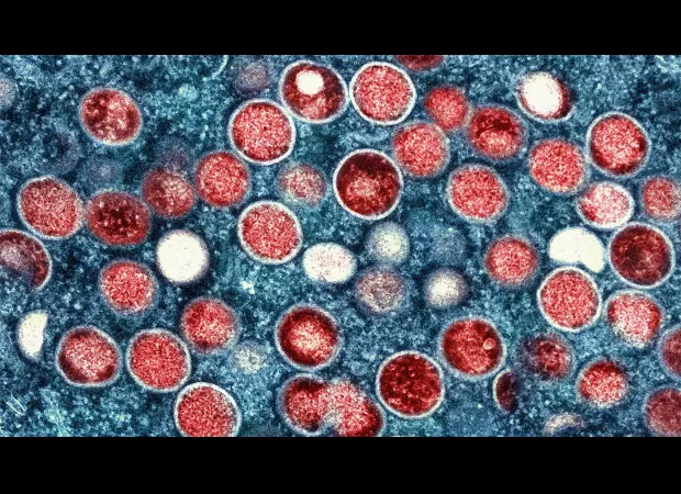 Thailand reports first case of contagious mpox in Asia.