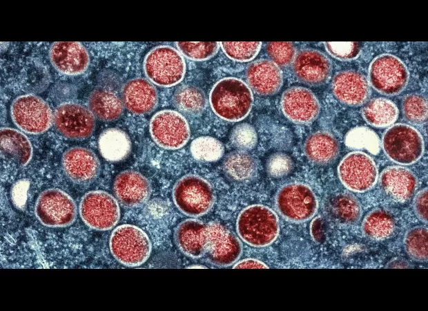 Travelers to Spain may have to deal with restrictions as mpox infection rates increase.