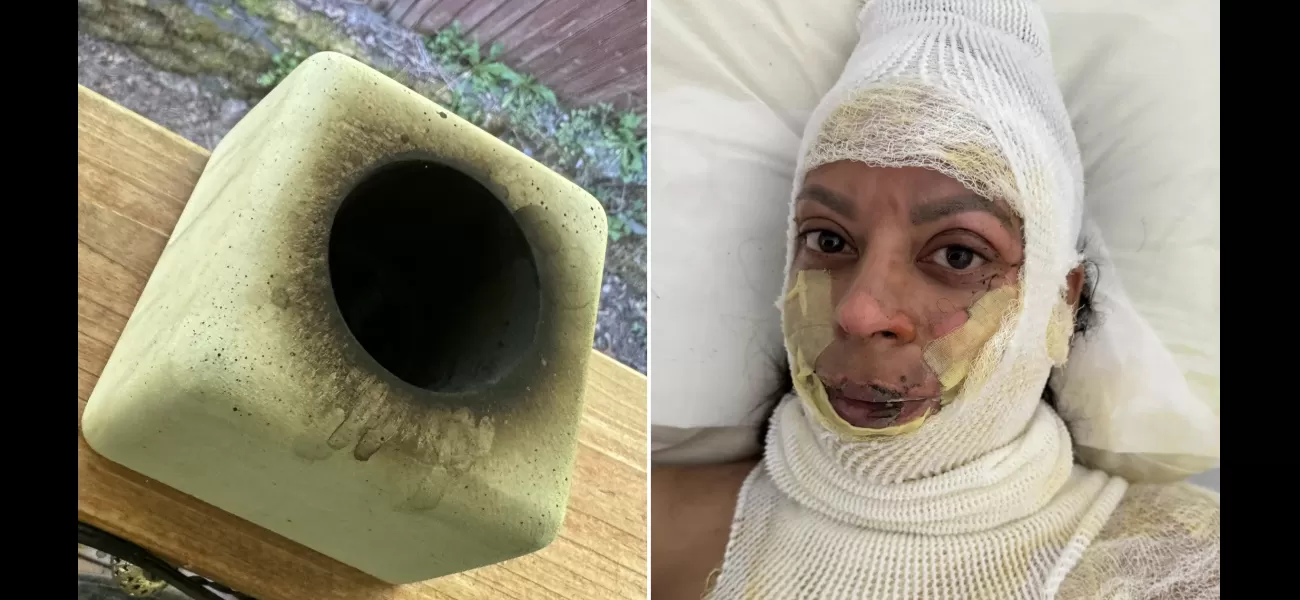 Mother's face burned off by portable fireplace explosion.