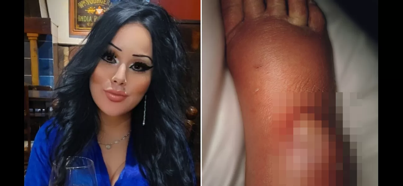 Woman's leg almost amputated due to false widow spider bite through fishnet stockings.