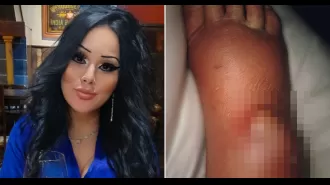 Woman's leg almost amputated due to false widow spider bite through fishnet stockings.