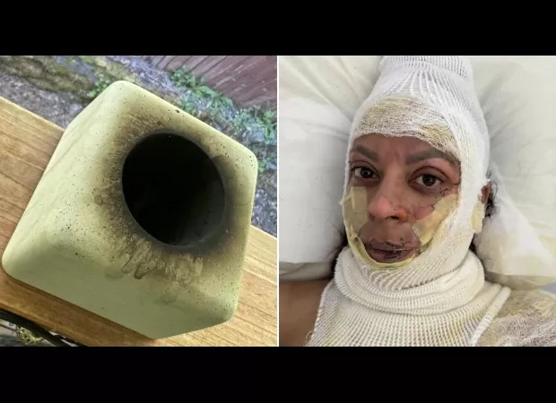 Mother's face burned off by portable fireplace explosion.
