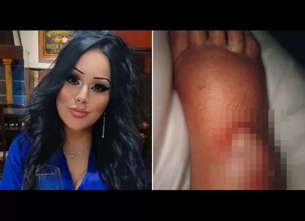 Woman's leg almost amputated due to false widow spider bite through fishnet stockings.