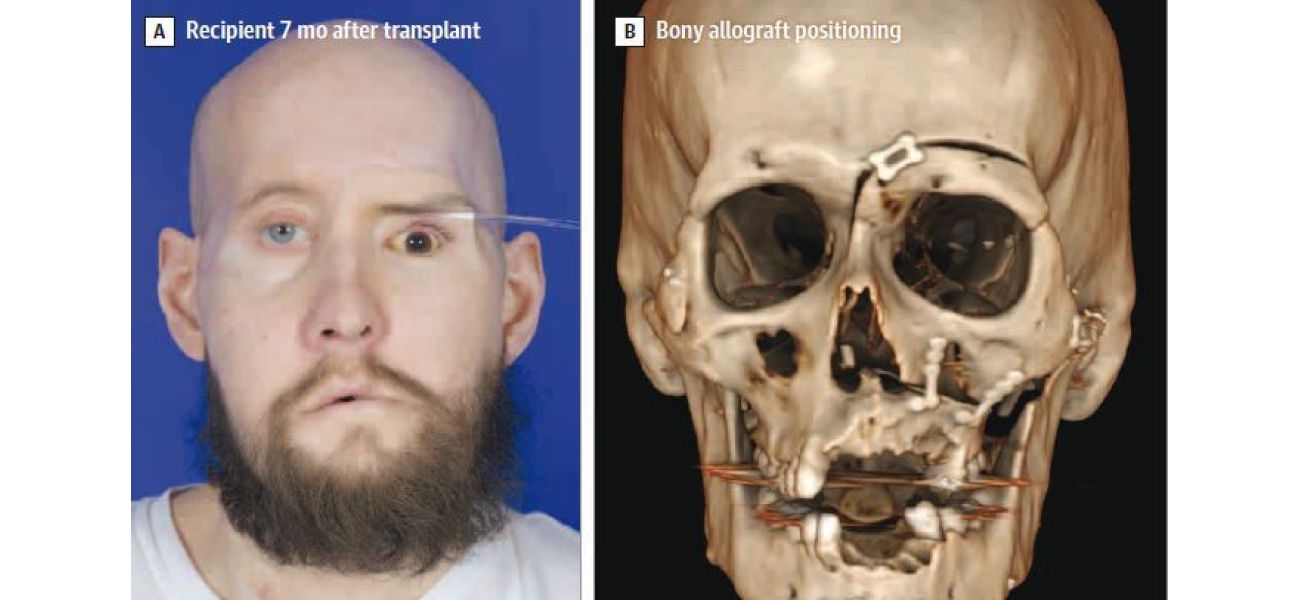 Doctors celebrate first eye transplant in history after achieving groundbreaking outcome.