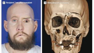 Doctors celebrate first eye transplant in history after achieving groundbreaking outcome.