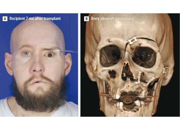 Doctors celebrate first eye transplant in history after achieving groundbreaking outcome.