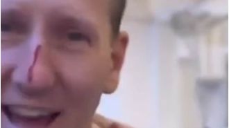 Former dancers on Strictly Come Dancing downplay allegations of bullying on the BBC show while a dancer's nose bleeds.