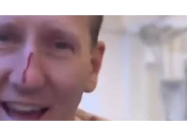 Former dancers on Strictly Come Dancing downplay allegations of bullying on the BBC show while a dancer's nose bleeds.